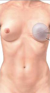 breast_implant_silicone_gel